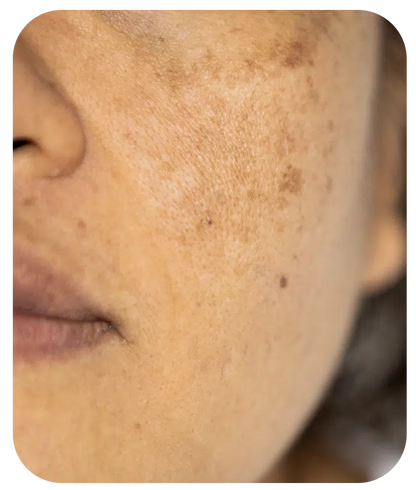 Retinol + Bakuchiol Serum 1%  - 1 fl oz